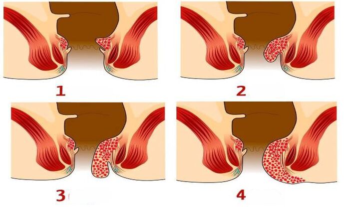comment les hémorroïdes apparaissent à différents stades